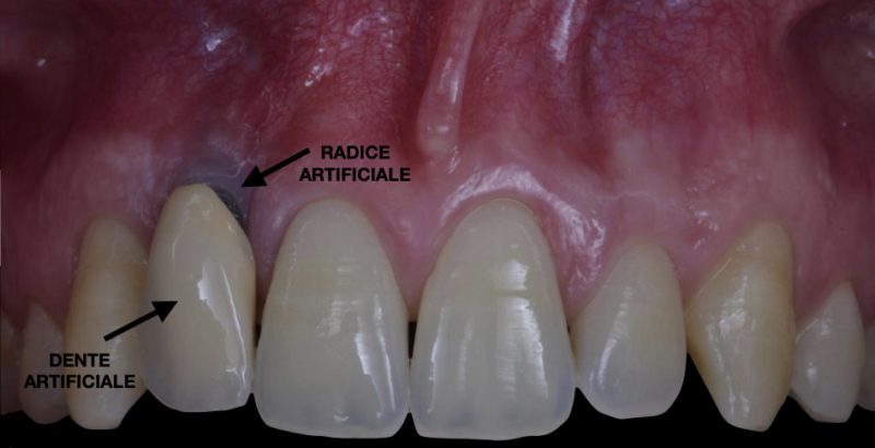 Quanto Costa Incapsulare Un Dente In Ceramica